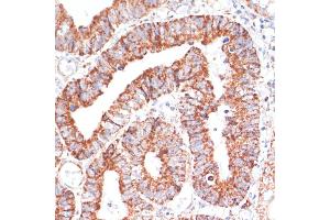 Immunohistochemistry of paraffin-embedded human colon carcinoma using MRPL46 antibody (ABIN7268574) at dilution of 1:100 (40x lens). (MRPL46 抗体  (AA 1-279))