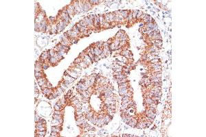 Immunohistochemistry of paraffin-embedded human colon carcinoma using MRPL46 antibody (ABIN7268574) at dilution of 1:100 (40x lens).