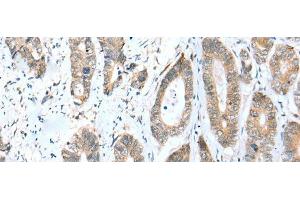 Immunohistochemistry of paraffin-embedded Human gastric cancer tissue using ACBD4 Polyclonal Antibody at dilution of 1:30(x200) (ACBD4 抗体)