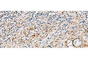 Immunohistochemistry of paraffin-embedded Human cervical cancer tissue using TMEM141 Polyclonal Antibody at dilution of 1:60(x200) (TMEM141 抗体)