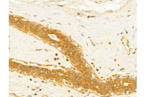 ABIN6263251 and ABIN6273008 at 1/100 staining Human normal tissues adjacent to breast cancer by IHC-P.
