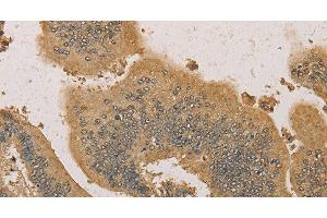 Immunohistochemistry of paraffin-embedded Human colon cancer tissue using PRDM14 Polyclonal Antibody at dilution 1:30 (PRDM14 抗体)