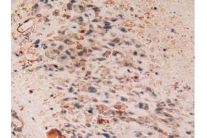 IHC-P analysis of Human Lung Cancer Tissue, with DAB staining. (Cytokeratin 7 抗体  (AA 91-394))