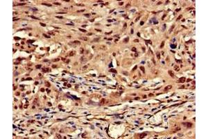 Immunohistochemistry of paraffin-embedded human lung cancer using ABIN7157380 at dilution of 1:100 (Cytokeratin 13 抗体  (AA 420-458))