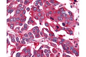 Anti-NEK7 antibody IHC of human Colon, Carcinoma. (NEK7 抗体  (Kinase Domain))