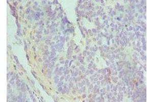 Immunohistochemistry of paraffin-embedded human endometrial cancer using ABIN7172842 at dilution of 1:100 (TGFBI 抗体  (AA 30-250))