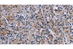 Immunohistochemistry of paraffin-embedded Human prostate cancer using KDM4D Polyclonal Antibody at dilution of 1:50 (JMJD2D 抗体)