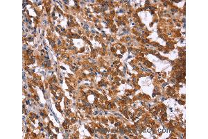 Immunohistochemistry of Human gastric cancer using HACE1 Polyclonal Antibody at dilution of 1:40 (HACE1 抗体)