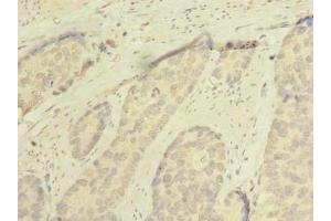 Immunohistochemistry of paraffin-embedded human gastric cancer using ABIN7168953 at dilution of 1:100 (C7orf45 抗体  (AA 56-244))