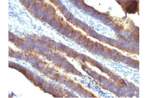 Formalin-fixed, paraffin-embedded human Colon Carcinoma stained with MUC3 Mouse Monoclonal Antibody (M3. (MUC3A 抗体)