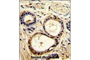 Formalin-fixed and paraffin-embedded human breast carcinoma with SRC8 Antibody (N-term), which was peroxidase-conjugated to the secondary antibody, followed by DAB staining. (SRC8 抗体  (N-Term))