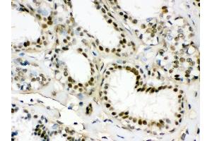 Anti- EWSR1 Picoband antibody, IHC(P) IHC(P): Human Mammary Cancer Tissue (EWSR1 抗体  (Middle Region))