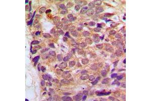 Immunohistochemical analysis of RGS10 staining in human breast cancer formalin fixed paraffin embedded tissue section. (RGS10 抗体  (Center))