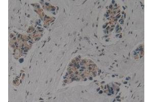 Detection of CK1 in Human Breast cancer Tissue using Polyclonal Antibody to Cytokeratin 1 (CK1) (Cytokeratin 1 抗体  (AA 487-644))