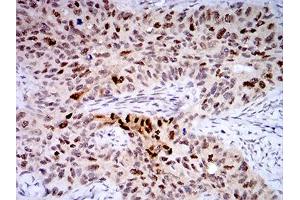 Immunohistochemical analysis of paraffin-embedded cervical cancer tissues using TTF1 mouse mAb with DAB staining. (TTF1 抗体  (AA 1-150))