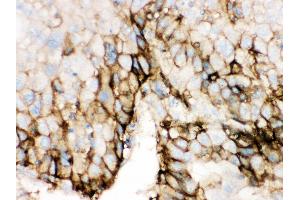 Anti- SLC2A2 Picoband antibody, IHC(P) IHC(P): Human Liver Cancer Tissue (SLC2A2 抗体  (C-Term))