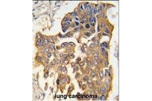 Formalin-fixed and paraffin-embedded human lung carcinoma tissue reacted with CASP9 antibody (Center) (ABIN392509 and ABIN2842072) , which was peroxidase-conjugated to the secondary antibody, followed by DAB staining. (Caspase 9 抗体  (AA 183-211))