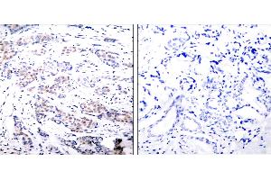 Immunohistochemical analysis of paraffin- embedded breast carcinoma. (ELK1 抗体  (Ser383))