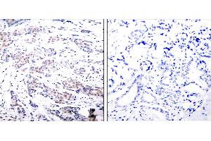 Immunohistochemical analysis of paraffin- embedded breast carcinoma.