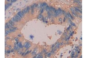 Detection of DDAH2 in Human Colorectal cancer Tissue using Polyclonal Antibody to Dimethylarginine Dimethylaminohydrolase 2 (DDAH2) (DDAH2 抗体  (AA 31-265))