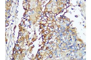 Immunohistochemistry of paraffin-embedded human esophageal using Carbonic Anhydrase 9 (C/G250) Rabbit mAb (ABIN1680827, ABIN3019284, ABIN3019285 and ABIN7101745) at dilution of 1:100 (40x lens). (CA9 抗体)