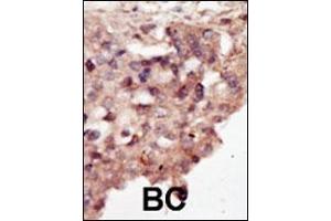 Formalin-fixed and paraffin-embedded human cancer tissue reacted with the primary antibody, which was peroxidase-conjugated to the secondary antibody, followed by DAB staining. (DAPK2 抗体  (N-Term))