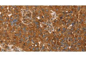 Immunohistochemistry of paraffin-embedded Human breast cancer tissue using TBC1D1 Polyclonal Antibody at dilution 1:45 (TBC1D1 抗体)
