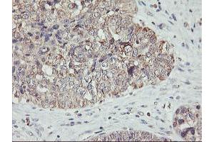 Immunohistochemical staining of paraffin-embedded Adenocarcinoma of Human ovary tissue using anti-AGPAT5 mouse monoclonal antibody. (AGPAT5 抗体)