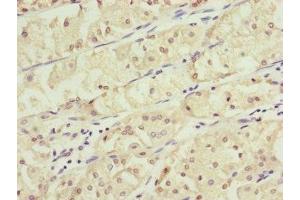 Immunohistochemistry of paraffin-embedded human gastric cancer using ABIN7157235 at dilution of 1:100 (KANSL3 抗体  (AA 1-200))