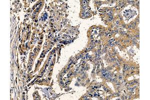 ABIN7094939 and ABIN7098995 at 1/100 staining human liver cancer by IHC-P.