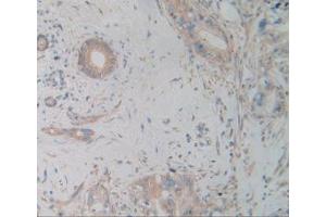 IHC-P analysis of Human Cholangiocarcinoma Tissue, with DAB staining.