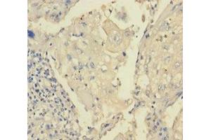 Immunohistochemistry of paraffin-embedded human lung cancer using ABIN7172870 at dilution of 1:100 (TRPM8 抗体  (AA 1-192))