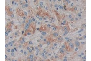 Detection of IL2 in Human Prostate cancer Tissue using Monoclonal Antibody to Interleukin 2 (IL2) (IL-2 抗体  (AA 21-153))