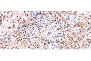 Immunohistochemistry of paraffin-embedded Human cervical cancer tissue using OSBPL2 Polyclonal Antibody at dilution of 1:55(x200) (OSBPL2 抗体)