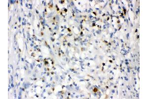 Anti- Lipocalin 2 Picoband antibody, IHC(P) IHC(P): Human Intestinal Cancer Tissue (Lipocalin 2 抗体  (AA 21-198))