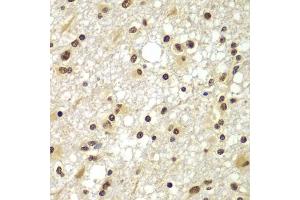 Immunohistochemistry of paraffin-embedded human brain cancer using ZNF20 antibody  at dilution of 1:100 (40x lens). (ZNF20 抗体  (AA 1-200))