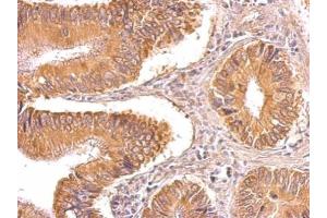 IHC-P Image TIP30 antibody detects TIP30 protein on human gastric cancer by immunohistochemical analysis. (HIV-1 Tat Interactive Protein 2, 30kDa (HTATIP2) 抗体)