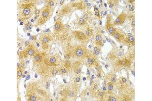 Immunohistochemistry of paraffin-embedded Human liver damage using EIF4G1 Polyclonal Antibody at dilution of 1:100 (40x lens). (EIF4G1 抗体)