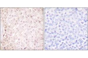 Immunohistochemistry analysis of paraffin-embedded human breast carcinoma tissue, using Stefin B Antibody. (CSTB 抗体  (AA 49-98))