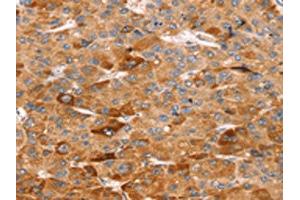 The image on the left is immunohistochemistry of paraffin-embedded Human liver cancer tissue using ABIN7192504(SLC5A11 Antibody) at dilution 1/25, on the right is treated with synthetic peptide. (Solute Carrier Family 5 (Sodium/inositol Cotransporter), Member 11 (SLC5A11) 抗体)