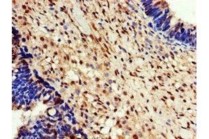 Immunohistochemistry of paraffin-embedded human ovarian cancer using ABIN7152101 at dilution of 1:100 (EEF2K 抗体  (AA 201-500))