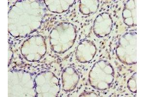 Immunohistochemistry of paraffin-embedded human colon cancer using ABIN7169893 at dilution of 1:100 (SUMO4 抗体  (AA 1-95))