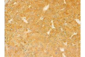 ABIN6262436 and ABIN6279508 at 1/100 staining human hepatocellular carcinoma by IHC-P. (ICAM5 抗体  (C-Term))