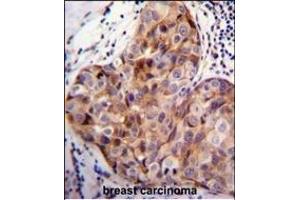 SCUBE2 Antibody (Center ) (ABIN655409 and ABIN2844955) immunohistochemistry analysis in formalin fixed and paraffin embedded human breast carcinoma followed by peroxidase conjugation of the secondary antibody and DAB staining. (SCUBE2 抗体  (AA 251-280))