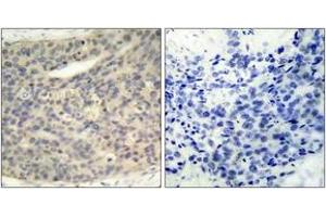 Immunohistochemistry analysis of paraffin-embedded human breast carcinoma, using LIMK1 (Phospho-Thr508) Antibody. (LIM Domain Kinase 1 抗体  (pThr508))