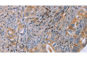 Immunohistochemistry of paraffin-embedded Human cervical cancer using GMFG Polyclonal Antibody at dilution of 1:50 (GMFG 抗体)