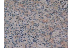 IHC-P analysis of Human Prostate Gland Cancer Tissue, with DAB staining. (CYLD 抗体  (AA 170-338))