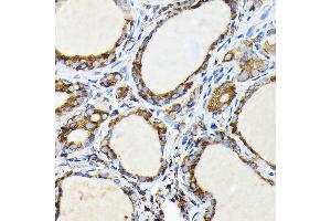 Immunohistochemistry of paraffin-embedded human thyroid cancer using FA Rabbit pAb (ABIN7267102) at dilution of 1:100 (40x lens). (FAM117A 抗体)