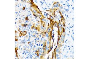Immunohistochemistry of paraffin-embedded human lung squamous carcinoma tissue using Cytokeratin 13 (KRT13) (KRT13) Rabbit mAb (ABIN7268089) at dilution of 1:100 (40x lens). (Cytokeratin 13 抗体)