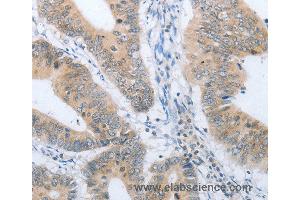 Immunohistochemistry of Human lung cancer using CHRNA10 Polyclonal Antibody at dilution of 1:50 (CHRNA10 抗体)